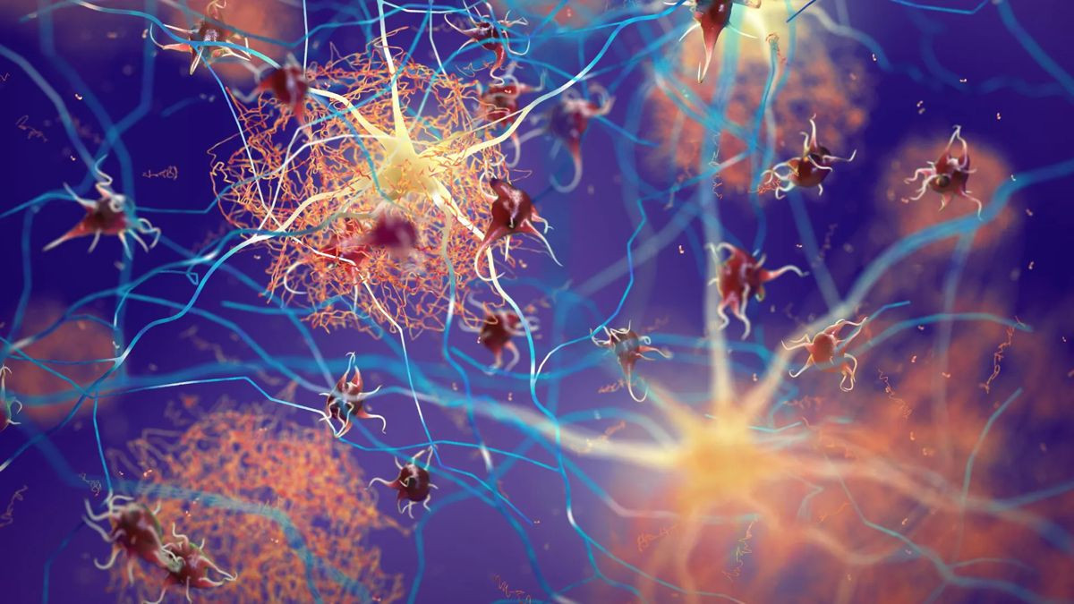 Νέα στρατηγική στην αντιμετώπιση της Νόσου Alzheimer πριν εκδηλωθεί