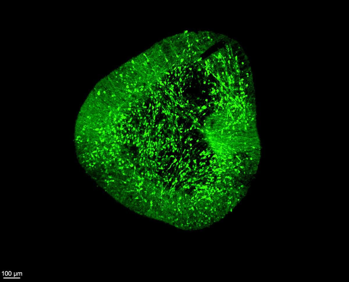 BrainSTEM: Ο χάρτης του ανθρώπινου εγκεφάλου που μπορεί να αλλάξει τη θεραπεία του Parkinson