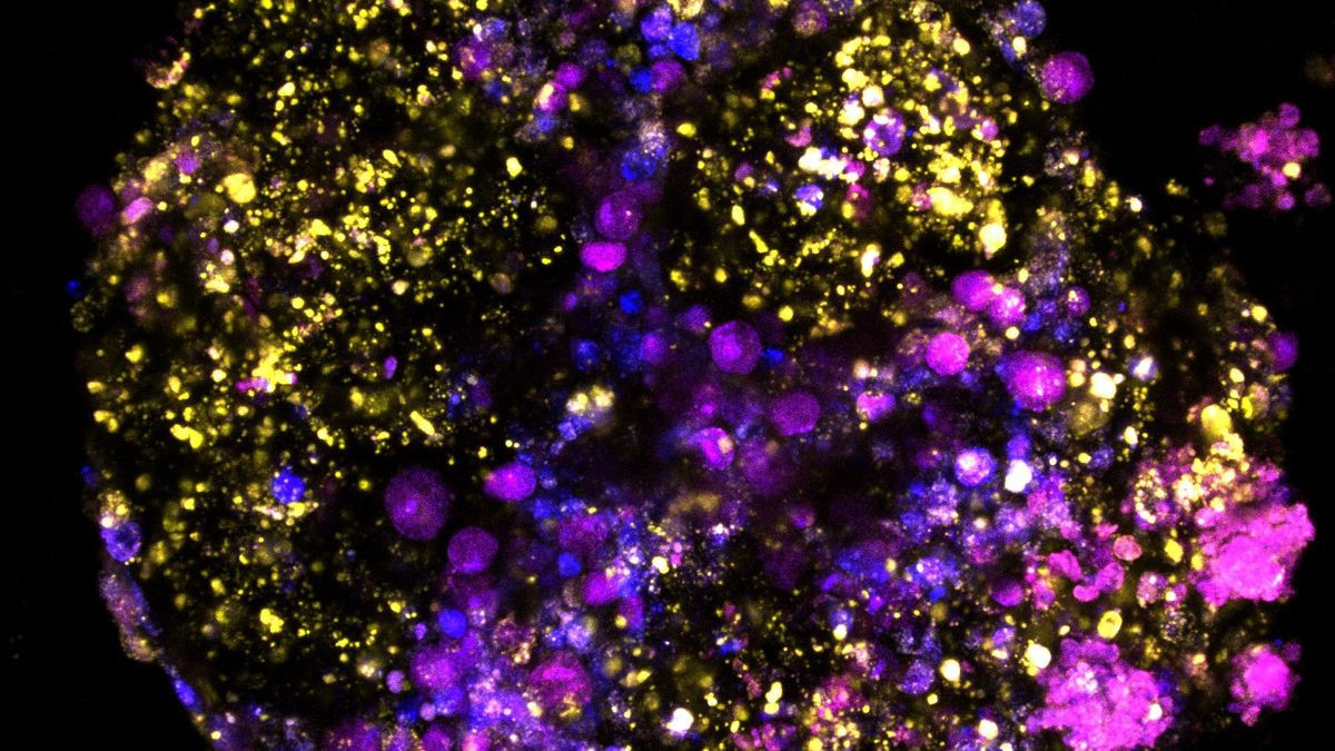 Το «Big Bang» του καρκίνου στο έντερο: Η στιγμή που το ανοσοποιητικό χάνει τη μάχη