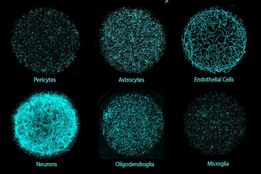 miBrains: Το MIT έφτιαξε «μίνι ανθρώπινα μυαλά» για τη μελέτη της Νόσου Alzheimer