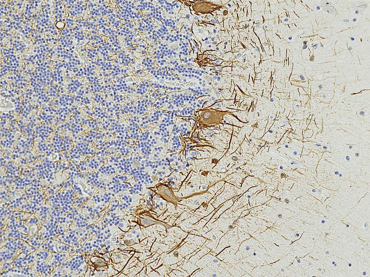 Σκλήρυνση κατά πλάκας: Δείκτες στο αίμα προειδοποιούν για την ασθένεια έως και 7 χρόνια πριν τα συμπτώματα Σκλήρυνση κατά πλάκας: Δείκτες στο αίμα προειδοποιούν για την ασθένεια έως και 7 χρόνια πριν τα συμπτώματα