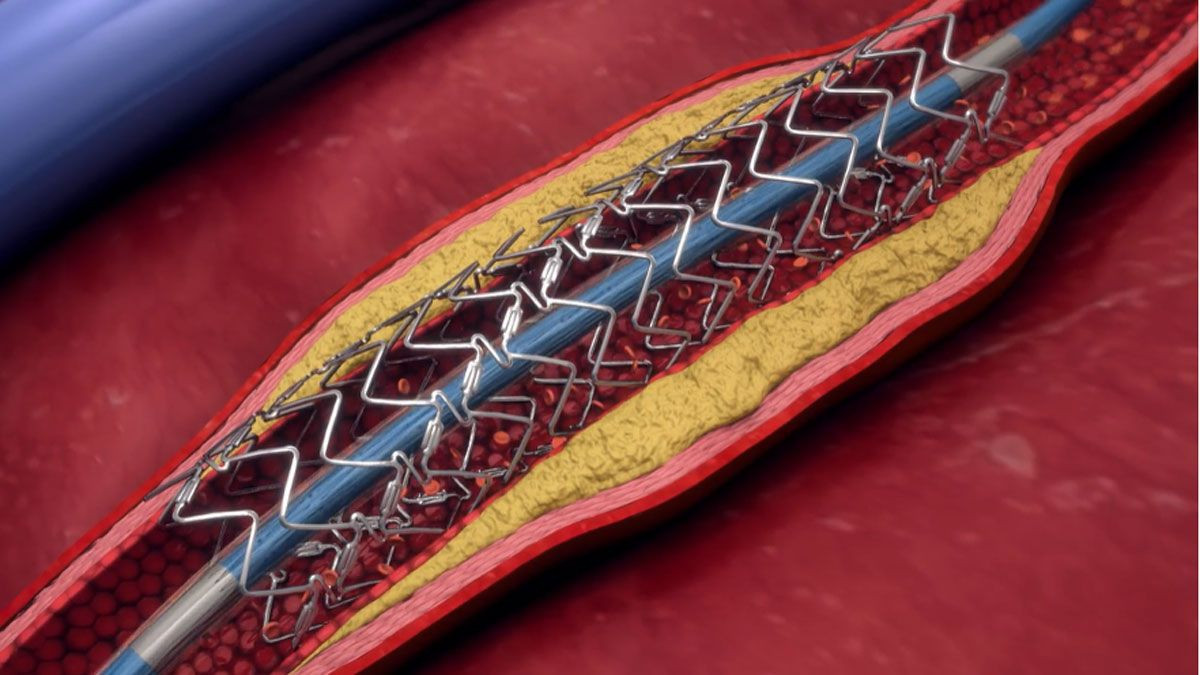 Πραγματοποιήθηκε η πρώτη στεφανιαία αγγειοπλαστική με καθοδήγηση Τεχνητής Νοημοσύνης!