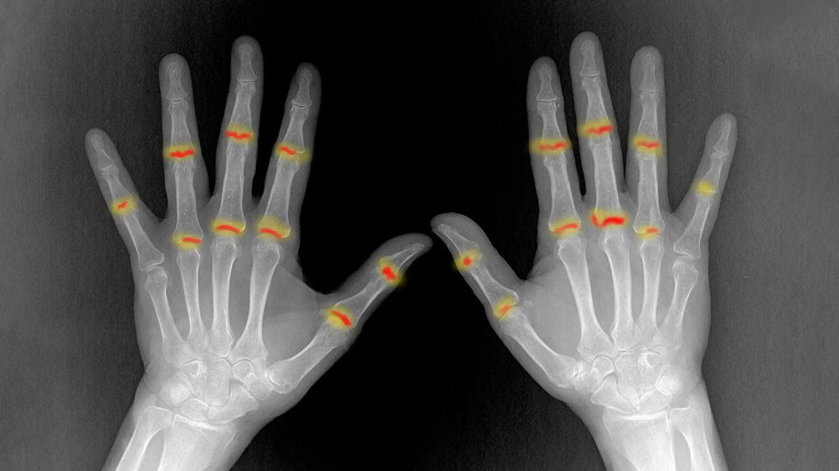 Ψωρίαση και Αρθρίτιδα: Εντοπίστηκε ο κρυφός μηχανισμός που συνδέει τις δύο νόσους