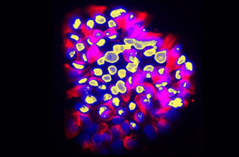 AI μοντέλο από το Πανεπιστήμιο της Γενεύης προβλέπει τις καρκινικές μεταστάσεις με ακρίβεια 80%