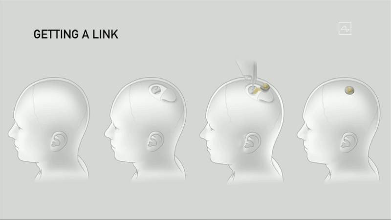 Neuralink: Ο Elon Musk ετοιμάζει τη νέα εποχή με το εμφύτευμα για τον εγκέφαλο |  Neuralink: Ο Elon Musk ετοιμάζει τη νέα εποχή με το εμφύτευμα για τον εγκέφαλο |